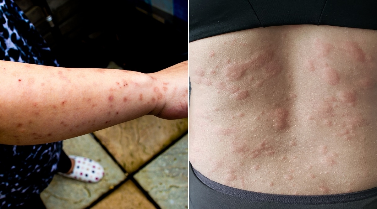 Can You Have A Allergic Reaction To Bed Bug Bites Pest Phobia