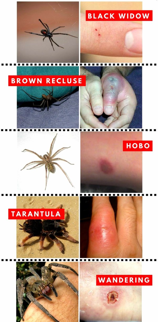 Can You Pop A Spider Bite Blister Pest Phobia