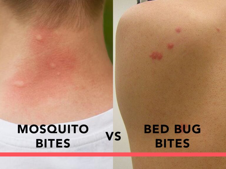 Cockroach Bite Vs Bed Bug Bite - PestPhobia