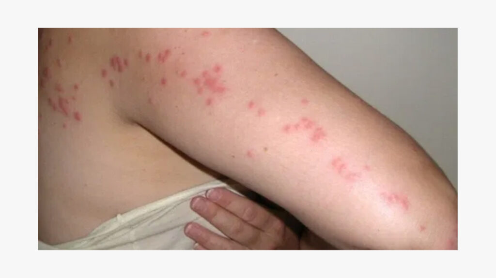 Can A Spider Bite Cause Hives All Over Body