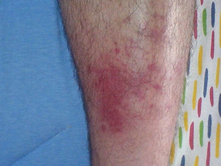 Can A Wasp Sting Cause Cellulitis - Pest Phobia
