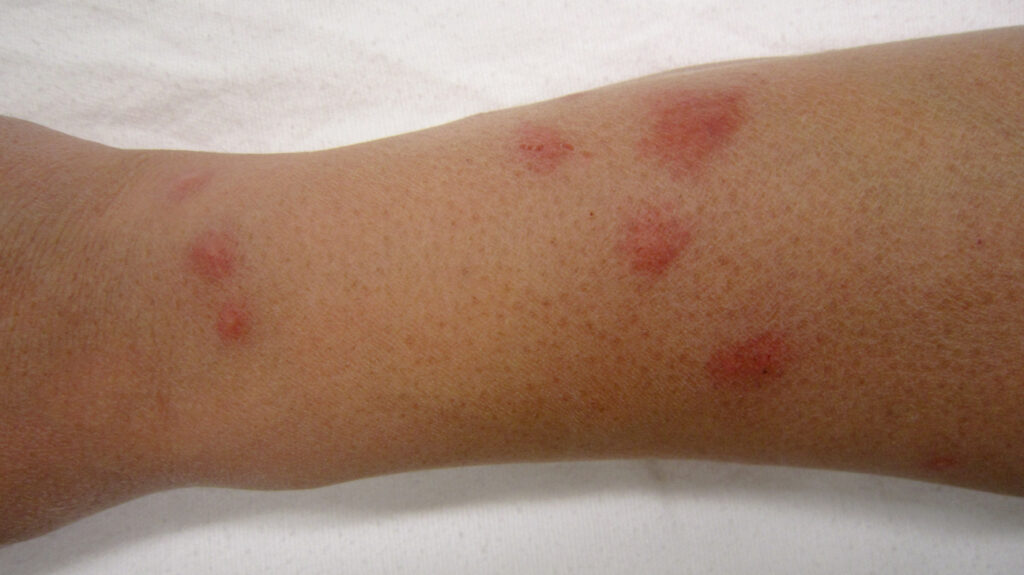 can-bed-bug-bites-cause-swelling-pest-phobia