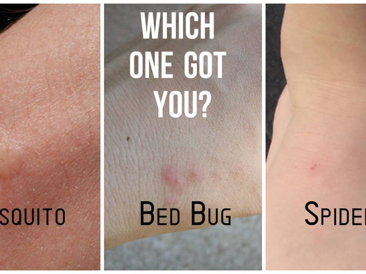 Can Bed Bug Bites Look Like Ringworm 