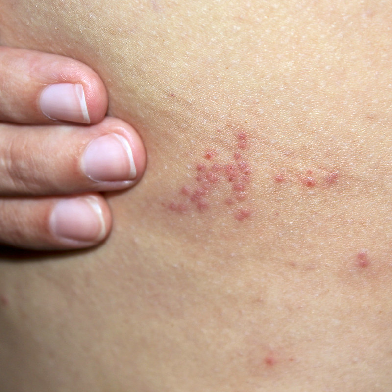 can-bed-bug-bites-show-up-days-later-pest-phobia