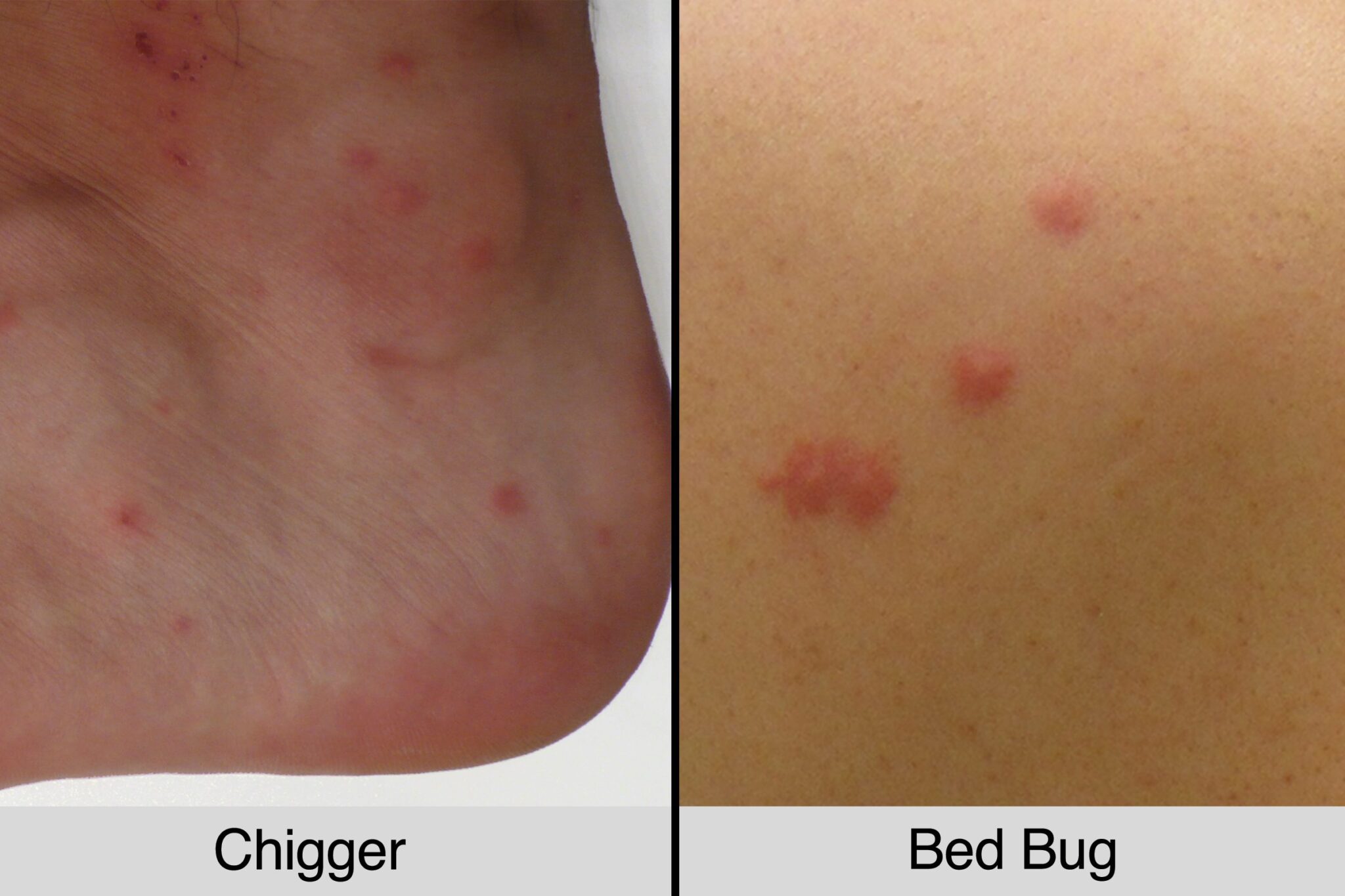 how-to-get-rid-of-bed-bug-bite-scars-pest-phobia