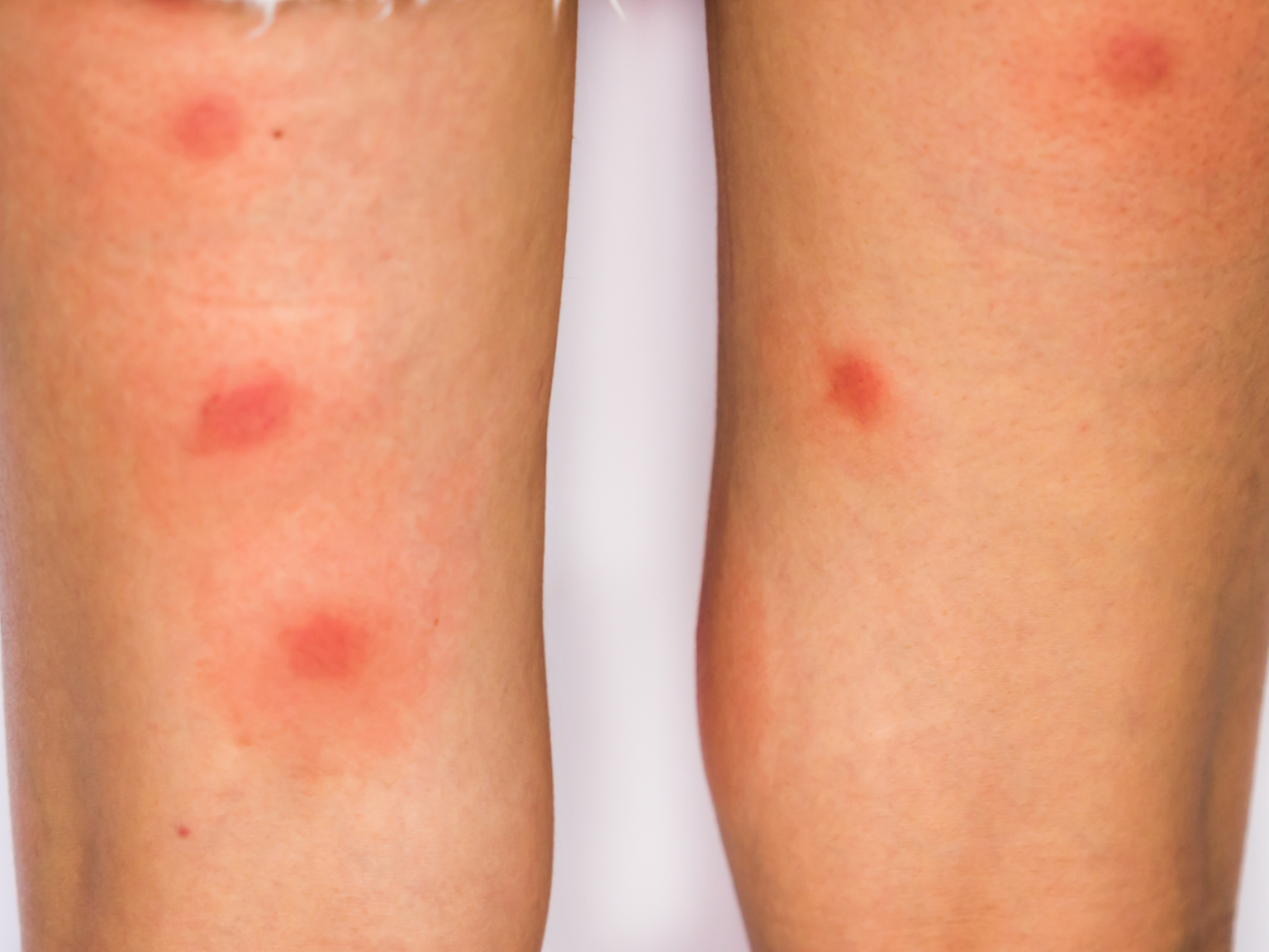 top-10-bed-bug-bites-treatment-hicare