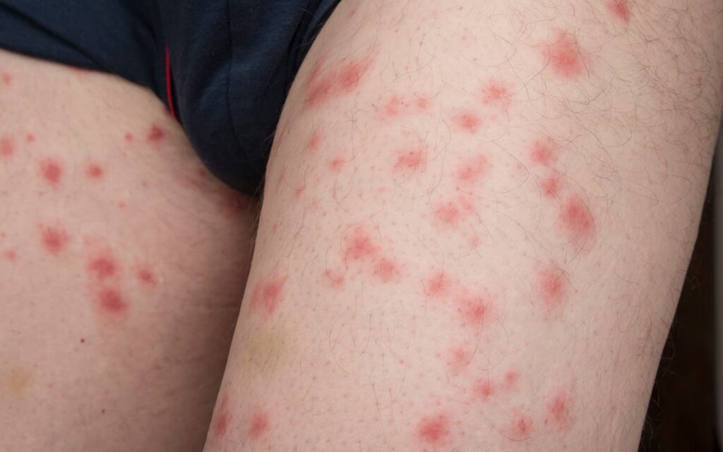 do-bed-bug-bites-cause-rashes-pest-phobia