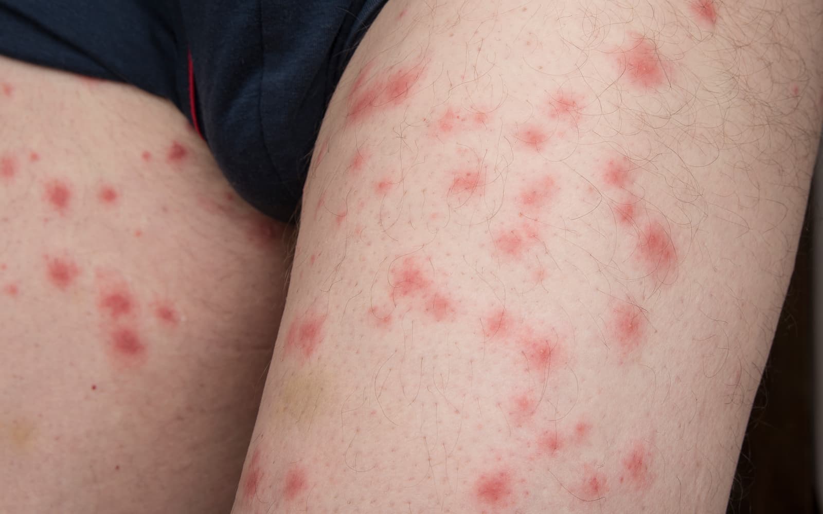 bed-bug-bite-signs-symptoms-pictures-and-treatment