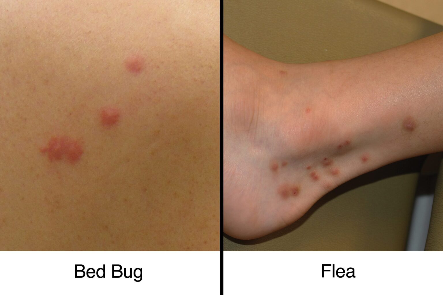 Do Bed Bug Bites Look Like Flea Bites Pest Phobia 8664