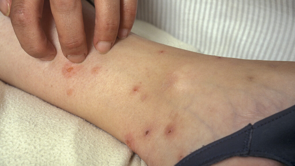 Why Do I Have Loads Of Bites On My Body