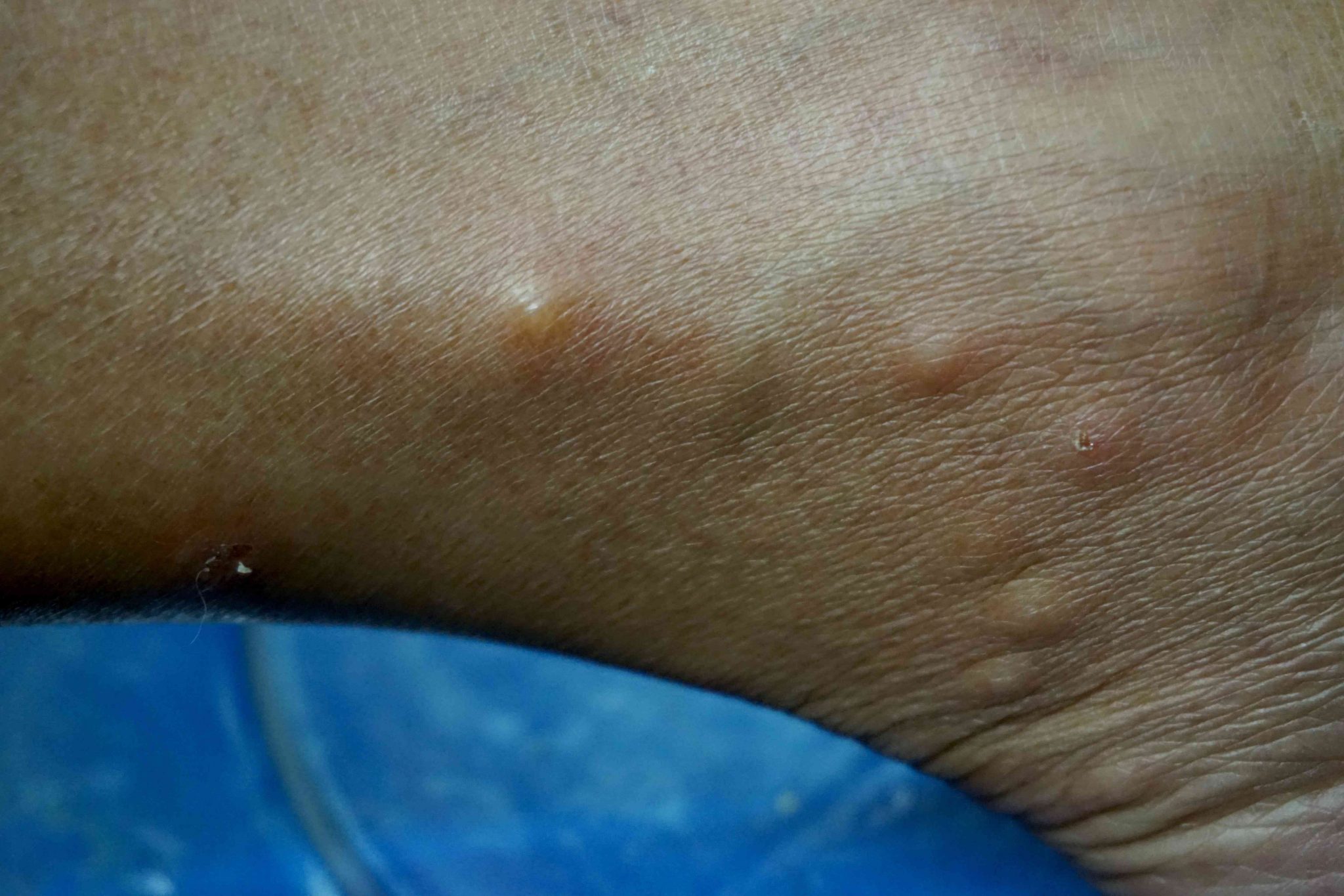 Picture Of Bed Bug Bites On African American Skin PestPhobia