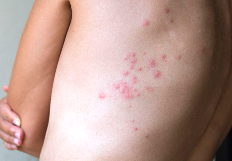 Pictures Of A Bed Bug Rash Pest Phobia