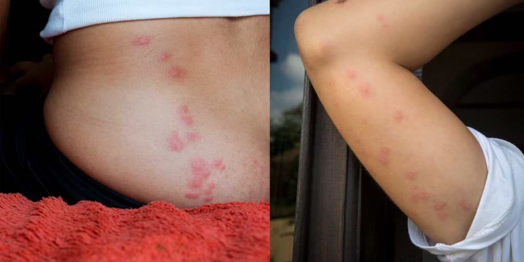 Does Itching Bed Bug Bites Make Them Worse