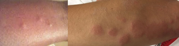 What do bedbug bites look like on a black person?